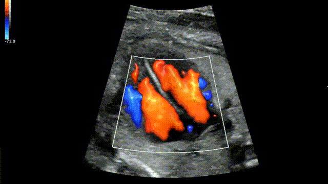 Corazon fetal, Ecocardiografia fetal, IPS FEMSALUD
